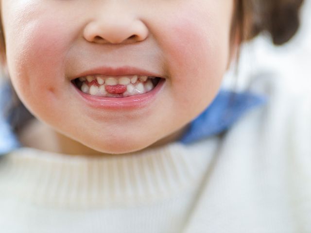 子どもの転倒による前歯の外傷 乳歯と永久歯で異なる対応|学習と健康