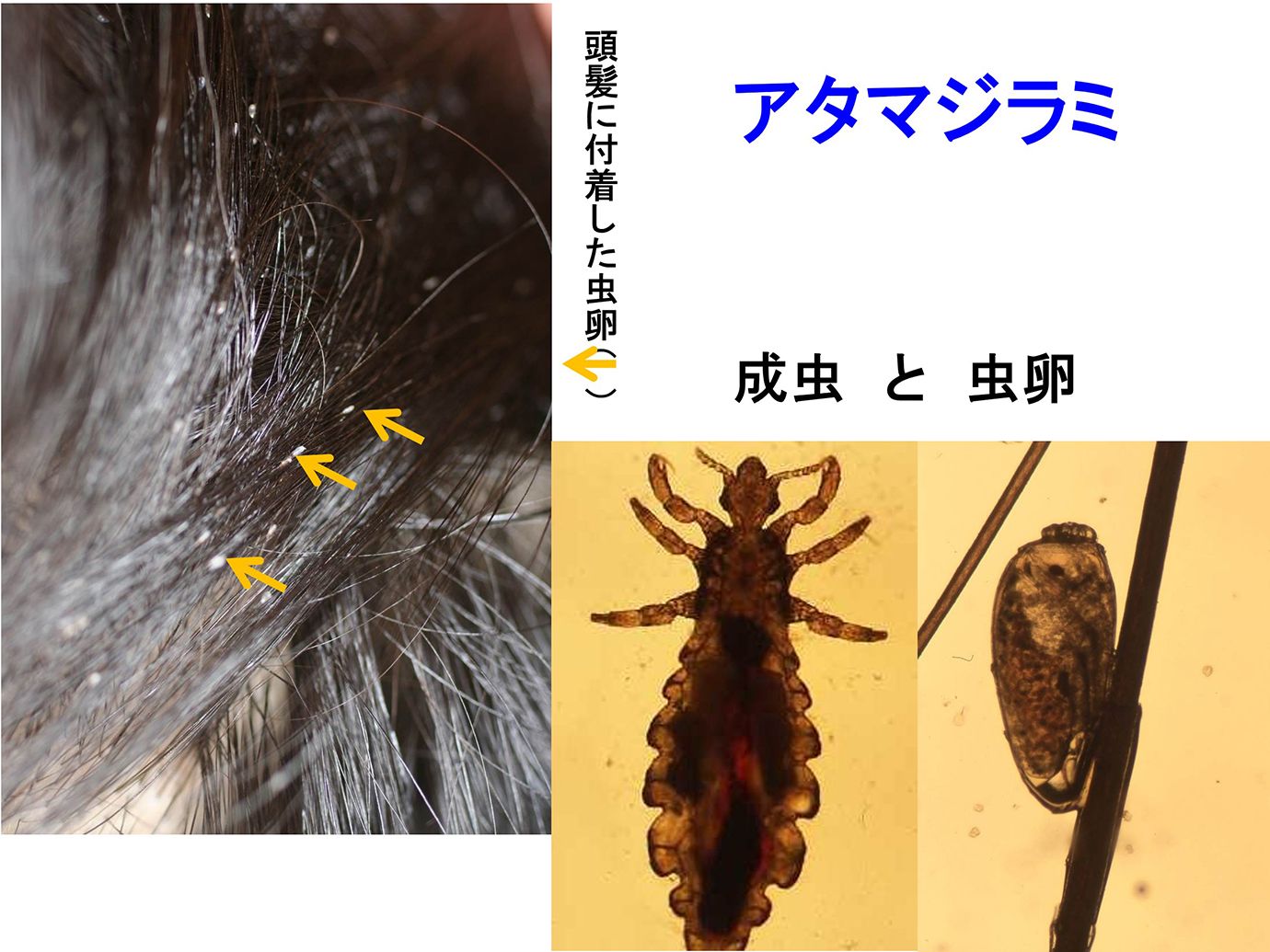シラミ と は